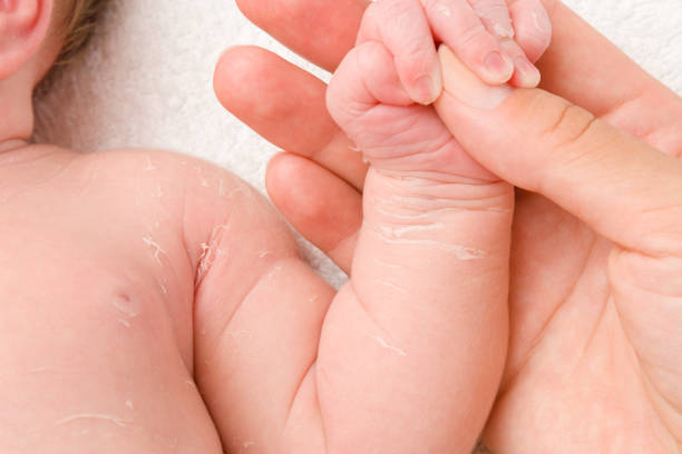 Dry Skin in Babies