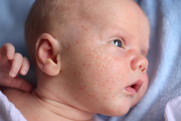 How To Get Rid Of Baby Acne?